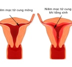 PHÁC ĐỒ ĐIỀU TRỊ NIÊM MẠC TỬ CUNG MỎNG