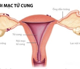 BÀI THUỐC CHỮA U LẠC NỘI MẠC