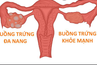 QUÁ TRÌNH ĐIỀU TRỊ GIẢM AMH CAO RA SAO