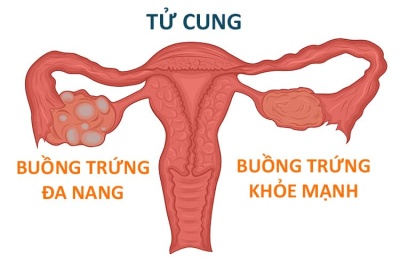 BUỒNG TRỨNG ĐA NANG THẬT SỰ LÀ THẾ NÀO