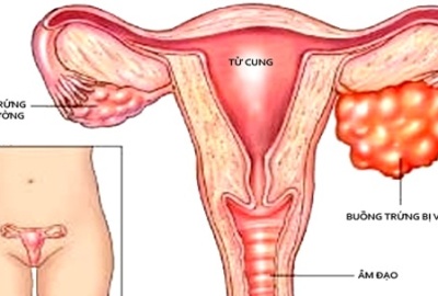 BUỒNG TRỨNG YẾU VÀ HOẠT ĐỘNG KÉM