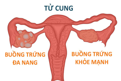 QUI LUẬT HÌNH THÀNH PHÁT TRIỂN BUỒNG TRỨNG ĐA NANG