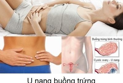 TÌM HIỂU U NANG THỰC THỂ BUỒNG TRỨNG 